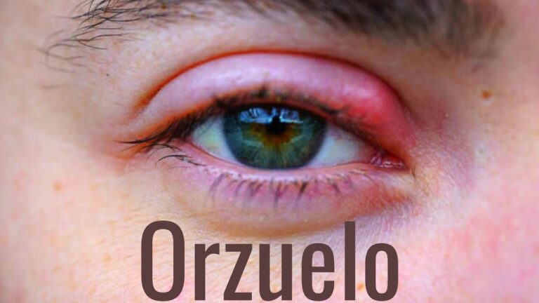 Consejos Efectivos Descubre Cómo Curar Las Perrillas En Los Ojos Fácilmente Educación Para